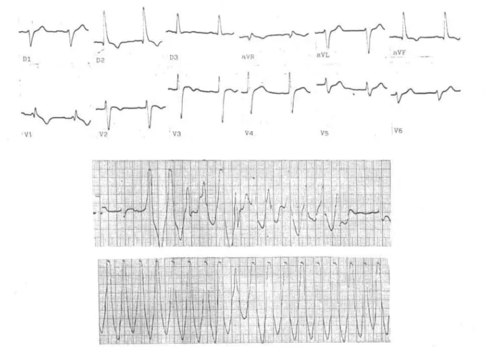 Figure 1. A 20 year-old m ale patient w ith C hagas' disease com plained of palpitations during physical efforts