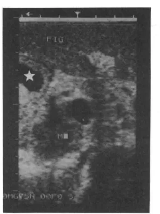 Figure 3 - Solid nodule with necrotic center, deviating right suprahepatic vein.