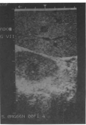 Figure 9 - A fte r p u n c tu re , th e re w a s a re d u c tio n in th e s iz e o f th e a b s c e s s 