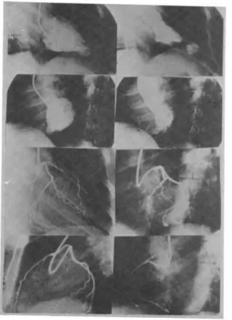 Figure 1 . E n d - d ia s to lic a n d e n d - s y s to lic le ft v e n tr ic u la r a n g io g r a p h ic fr a m e s in a p a tie n t w ith c h r o n ic C h a g a s ' h e a r t d is e a s e s h o w in g a p ic a l a n e u r y s m a n d in fe r io r d y s 