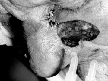 Figure 1 - Case 5: collocation of thrombin and fibrinogen, after the excision of cutaneous tumor (BCC).