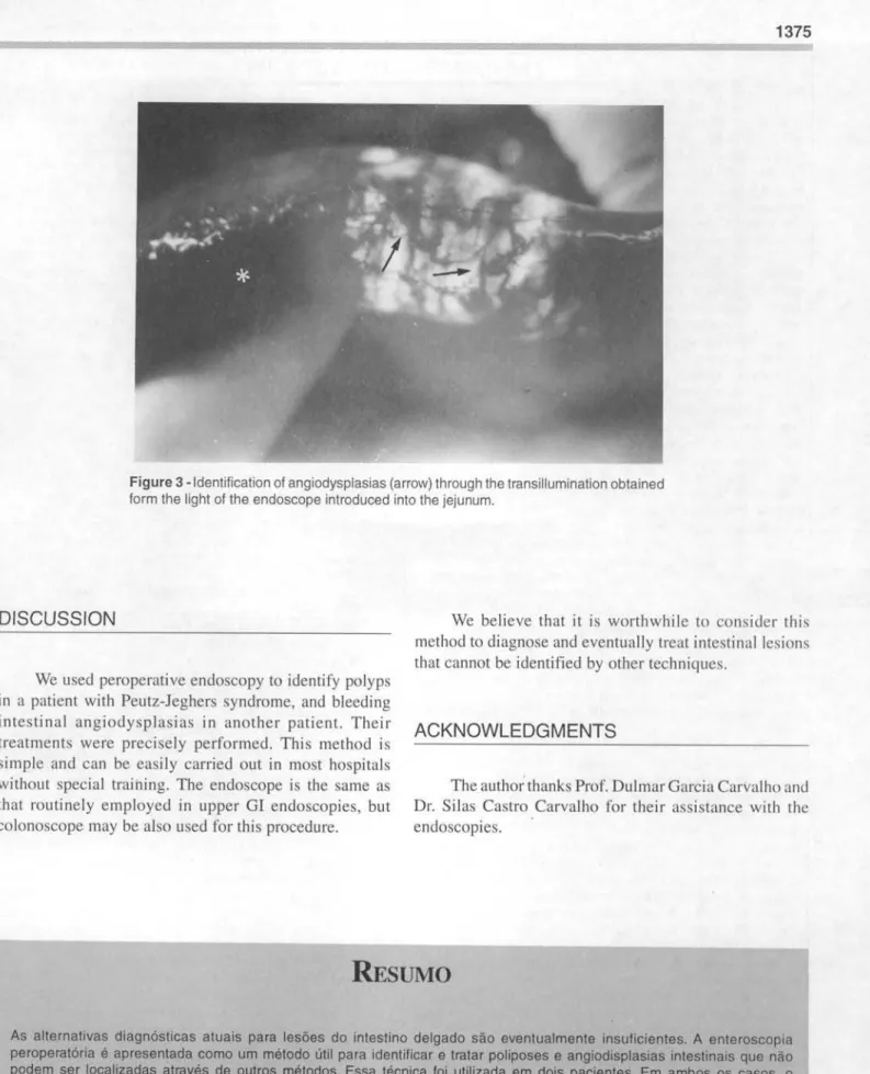 Figure 3 -Identification of angiodysplasias (arro\tv)through the transillumination obtained form the light of the endoscope introduced into the jejunum.