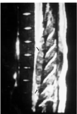 Figure 1 - Sagittal magnetic resonance imaging, at diagnosis, demonstrating posterior epidural mass with compression of the spinal cord from T4 through T8 (arrows).