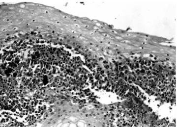 Figure 3 - Vaginal biopsy showed cells pigmented by melanoma, superficially invasive into the stroma