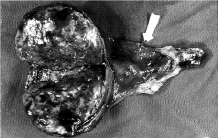 Figure 2. Macroscopic appearence of surgical specimen presenting enormous tumoral mass in the fundus of the gallbladder.