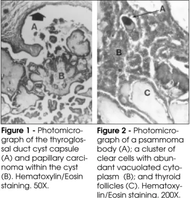 Figure 1 - Photomicro- Photomicro-graph of the  thyroglos-sal duct cyst capsule (A) and papillary  carci-noma within the cyst (B)