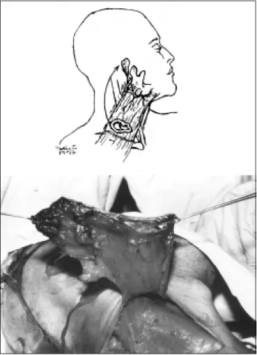 Fig. 3. Intraoperative stage of the second surgical step. 3-A: Schematic illustration of the 180 o  rotation performed with the PCMSF under the cervical skin.