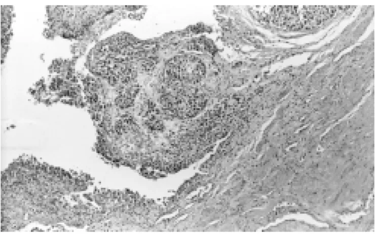 Fig. 1 - Ureter: transitional cell carcinoma (Hematoxylin Eosine: 10.0 x 2.5 x 3.0).