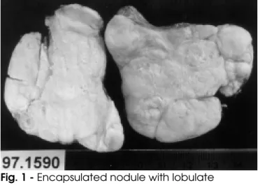Fig. 2 -  Double epithelial and lymphocytic cell popula- popula-tion, with “starry sky” appearance (Hematoxylin Eosine).