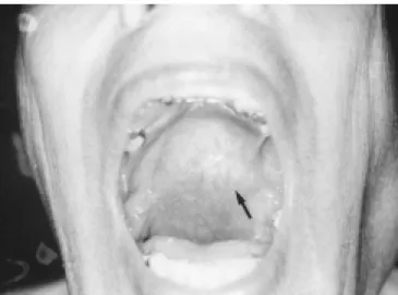 Figure 2 : CT scan in a coronal section, showing the tumor in the parapharyngeal space (arrow).