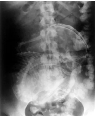 Figure 1. Calcified Abdominal Pregnancy - Abdominal X-ray.