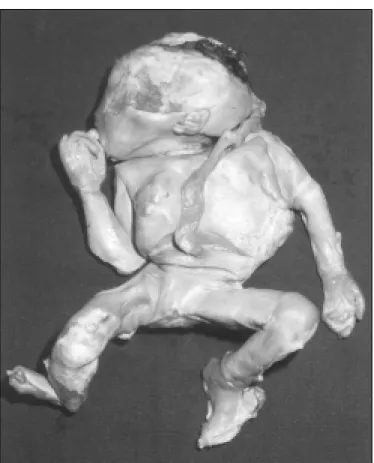 Figure 3. Calcified Abdominal Pregnancy - Fetus after dissection of calcified ovular membrane.