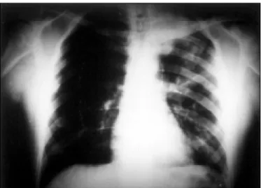 Figure 1. Chest X-ray revealing left upper lobe atelectasis.