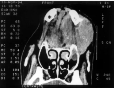 Figure 2. CT scan of a capsulated mass involving the mandible with septa and deviation of the surrounding tissues.