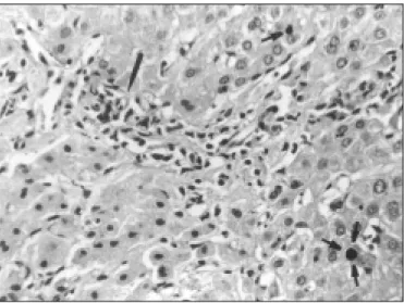 Figure 1. Lymph node biopsy specimen from patient showing typical