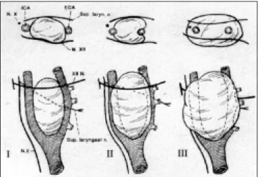 Figure 3 - The classification of Shambin et al. 10  of the difficulty of surgical resection.