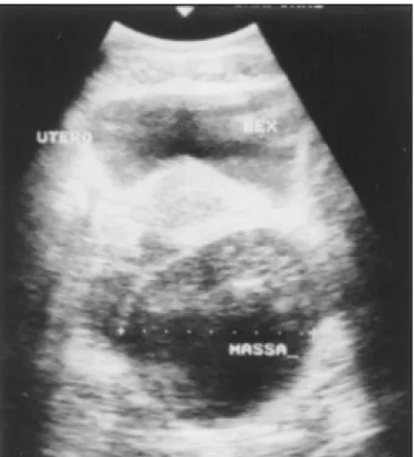 Figure 3 - Case 1, wall of the cystic neoplasm presenting a microcystic area.