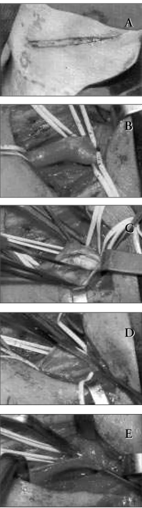 Figure 1. Carotid endarterectomy – Technical aspects.
