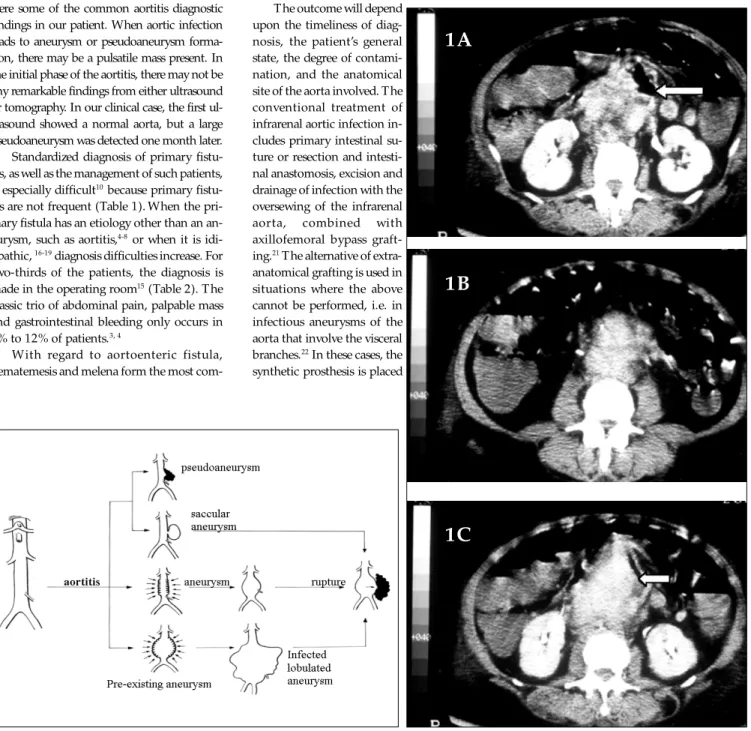 Figure 1. CT scan reveals a large pseudoaneurysm with air close to aortic wall (arrows).