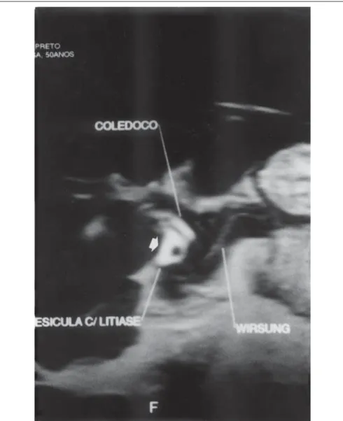 Figure 1. Cholangioresonance with an image interpreted at that time as “gallbladder with lithiasis” (white arrow) (case 2).