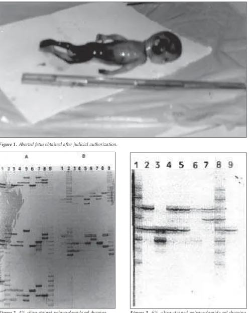 Figure 2. 4% silver-stained polyacrylamide gel showing CT T, F13A01 and FESFPS typing of victim, fetus and suspects