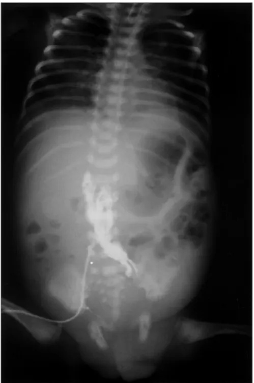 Figure 1. Right femoral vein catheter. Contrast injection demonstrates retroperitoneal extravasation that occurred five days after the catheter placement.