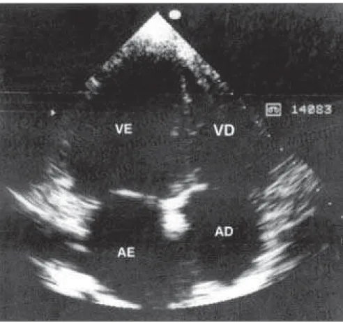Figure 1. Two-dimensional echocardiogram in the 4-chamber view, showing general dilatation.