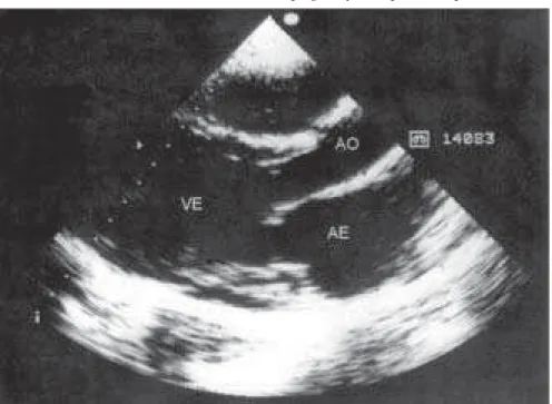 Figure 3. Echocardiogram showing outlet of left ventricle with dilated chambers.