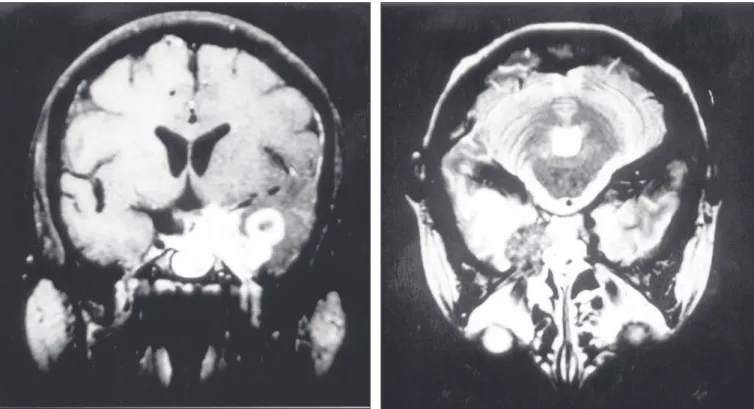 Figure 1. Coronal magnetic resonance imaging of the brain in the T1-weighted series after gadolinium injection, showing a lesion over the left temporal lobe in its mesial aspect and infiltrating the left cavernous sinus, with high signal.