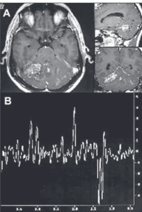 Figure 3. A- Magnetic resonance imaging of the brain in the axial, sagittal and coronal planes (T 1 -weighted),  show-ing parietal lesion with homogeneous postgadolinium enhancement, typical of meningioma