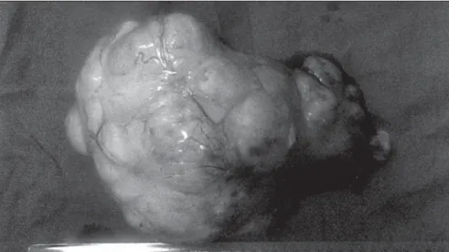 Figure 1. Macroscopic appearance of surgical specimen of a left ovarian thecoma.