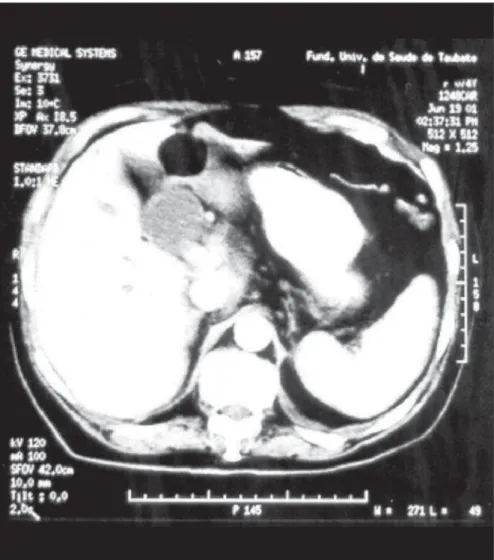 Figure 3. DISIDA scan after biliary-enteric bypass, showing the presence of dynamic biliary excretion.
