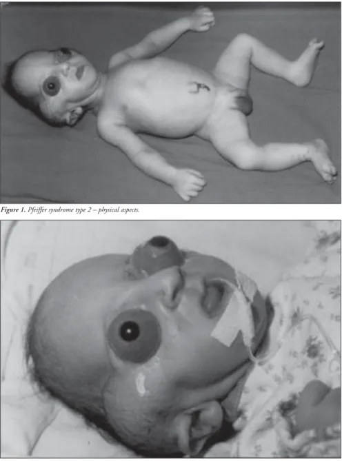Figure 1. Pfeiffer syndrome type 2 – physical aspects.