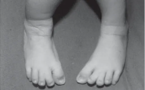 Figure 3. Broad big toes and cutaneous syndactyly between the second and third toes.