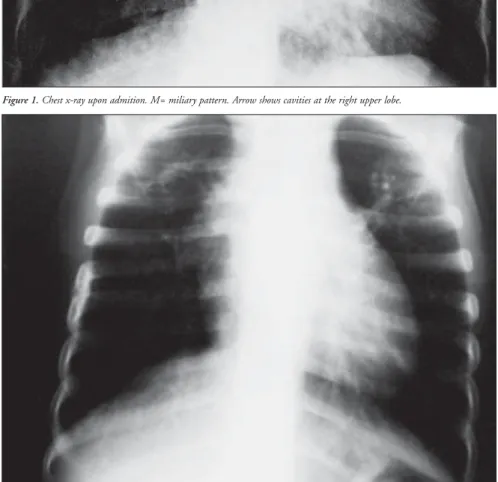 Figure 1. Chest x-ray upon admition. M= miliary pattern. Arrow shows cavities at the right upper lobe.