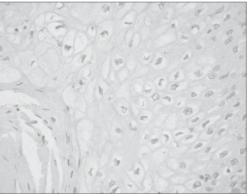 Figure 1. Macroscopic appearance: verrucous character of the neoplasm, involving the entire vesical wall (left)