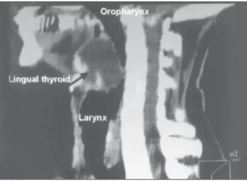 Figure 4. Lingual thyroid in the base of the tongue ready for resection via oral approach (A).