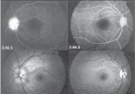 Figure 1.  Bottom: Photograph showing rare dot and blot hemorrhages and blurring of optic disc in the left eye