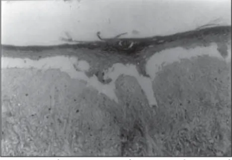 Figure 7. Epidermis reconstructed in vitro, in the process of separation from the dead de-epidermized human dermis.