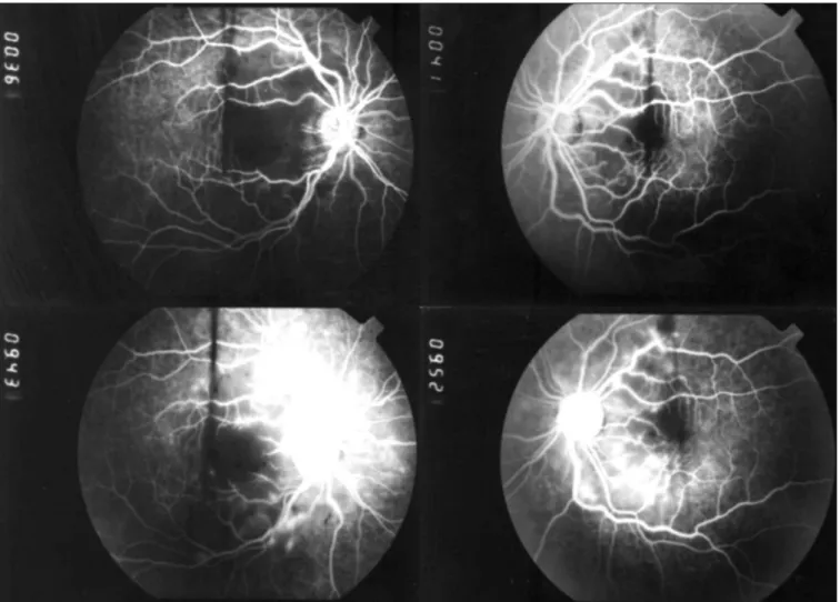 Figure 2. Early (top) and late (bottom) phases of the fluorescein angiogram in a 35-year-old man with acute pancreatitis who suffered  loss of visual acuity during clinical examination in the emergency room; note that the late venous phase shows hypofluore