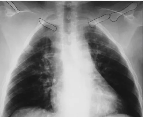 Figure 2. Posteroanterior view of chest radiograph showing the position of clavicular  fragments in a woman with cleidocranial dysostosis.