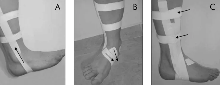 Figure 1. Schematic representation of taping technique. (A) Two strips of adhesive tape around the ankle about 5 and 10 centimeters  above the lateral and medial malleoli were attached, and another tape strip was placed, passing over the medial malleolus, 