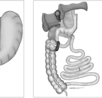 Figure 1. Sleeve gastrectomy being  performed using a laparoscopic linear  cutting stapler