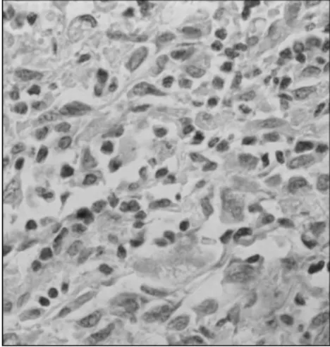 Figure 5. Tumor cells with positive reacti- reacti-vity for S100 (1,000 X) in  immunochemis-try of a peripheral nerve sheath tumor.