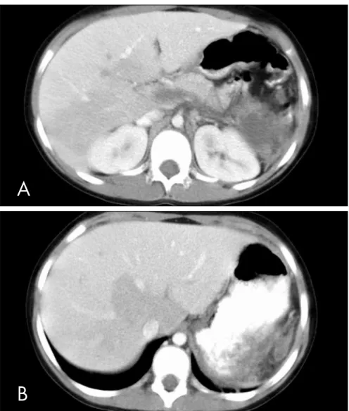 Figure 1A and 1B. Abdominal computed tomography scan on the eighth postopera- postopera-tive day following laparoscopic splenectomy, showing thrombosis of the splenic vein,  main portal vein, right and left portal veins, and portions of the smaller intrahe