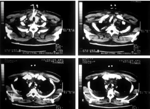 Figure 4. Cervical computed tomography  scan showing gas in lateropharyngeal  space, and also parapharyngeal and  retropharyngeal bilateral abscess.
