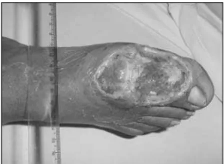 Figure 2. Sponge ﬁ tted onto a diabetic  foot wound.