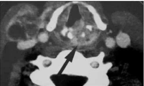 Figure 1. Axial computed tomography scan with lesion infi ltrating posterior half of  vocal fold, arytenoid cartilage and surrounding tissues (black arrow)