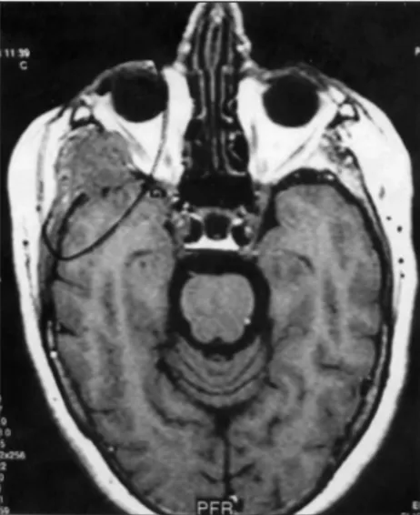 Figure 2. Invasion of the central nervous  system by adenoid cystic carcinoma as  shown in magnetic resonance imaging.