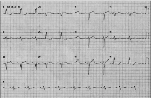 Figure 1. A 12-lead electrocardiogram of a 58-year-old female patient who presented  to our institution (Hospital São Francisco, Porto Alegre) with a history of dyspnea during  moderate effort, with asthenia and fatigue, accompanied by palpitations, showin